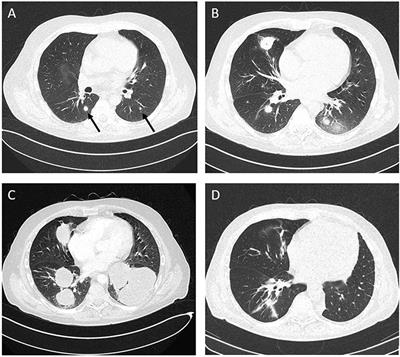 Refractory Epstein-Barr Virus (EBV)-Related Post-transplant Lymphoproliferative Disease: Cure by Combined Brentuximab Vedotin and Allogeneic EBV-Specific T-Lymphocytes